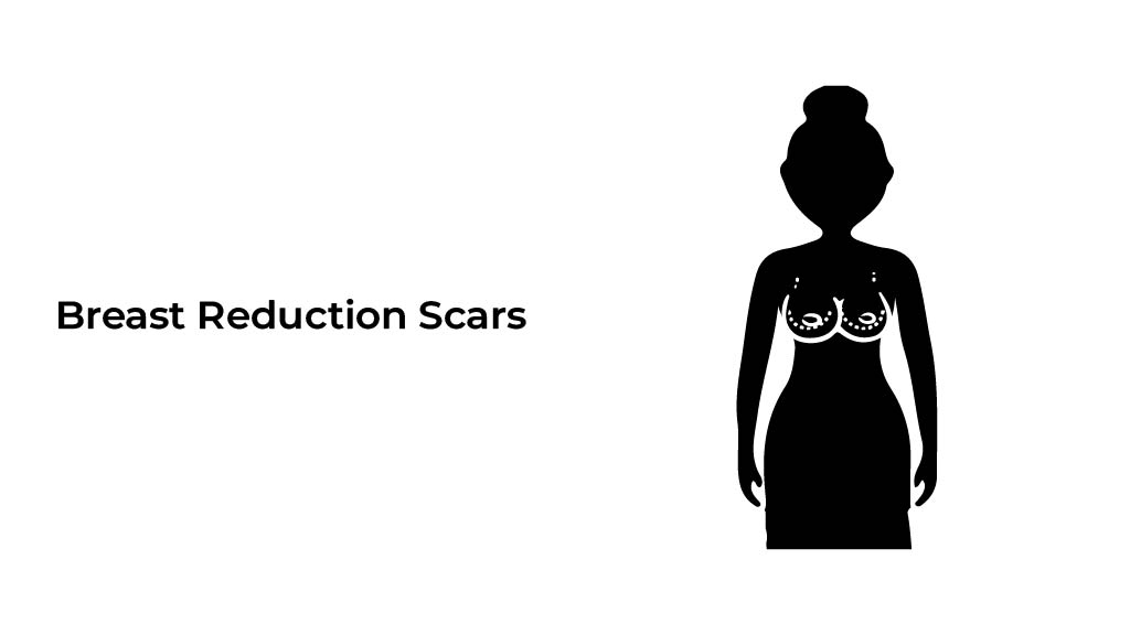 Breast-Reduction-Scars