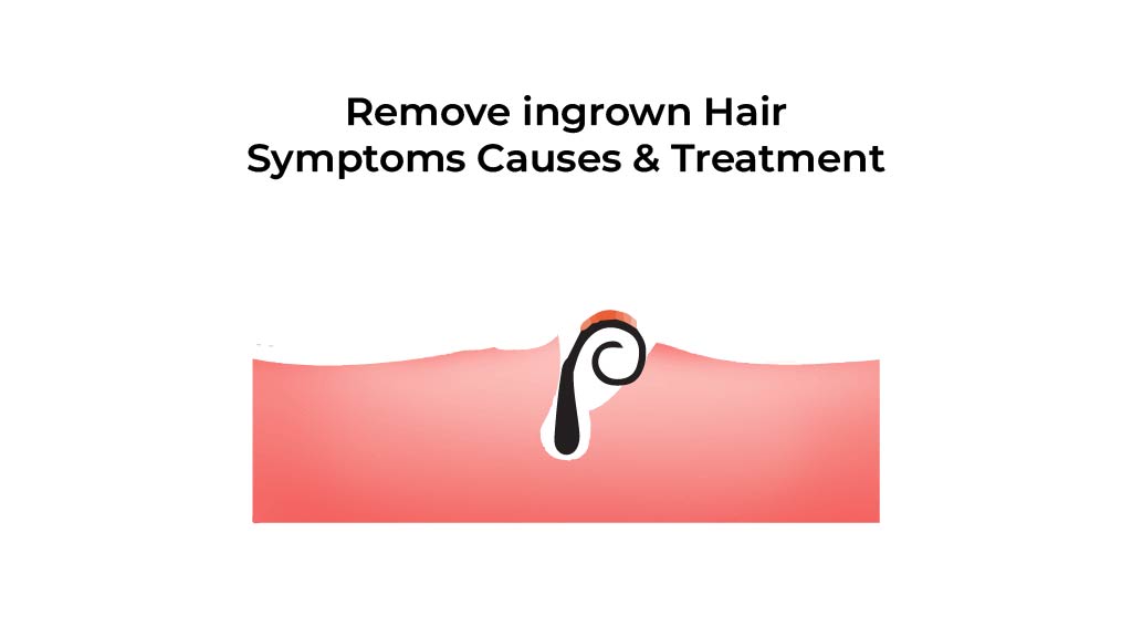 Remove-ingrown-Hair-Symptoms-Causes-&-Treatment-[Recovered]-01