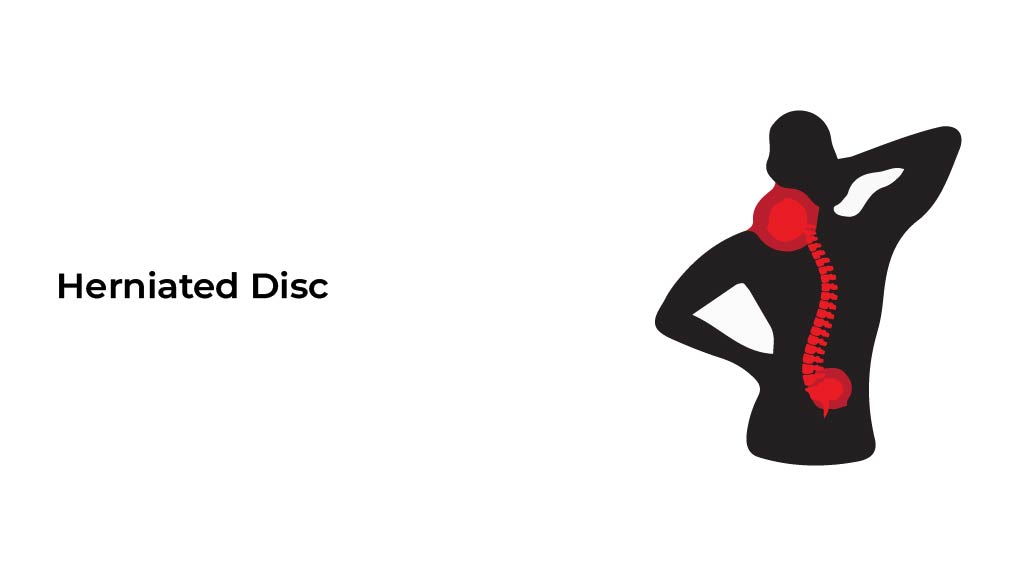 Herniated-disc-[Recovered]-01