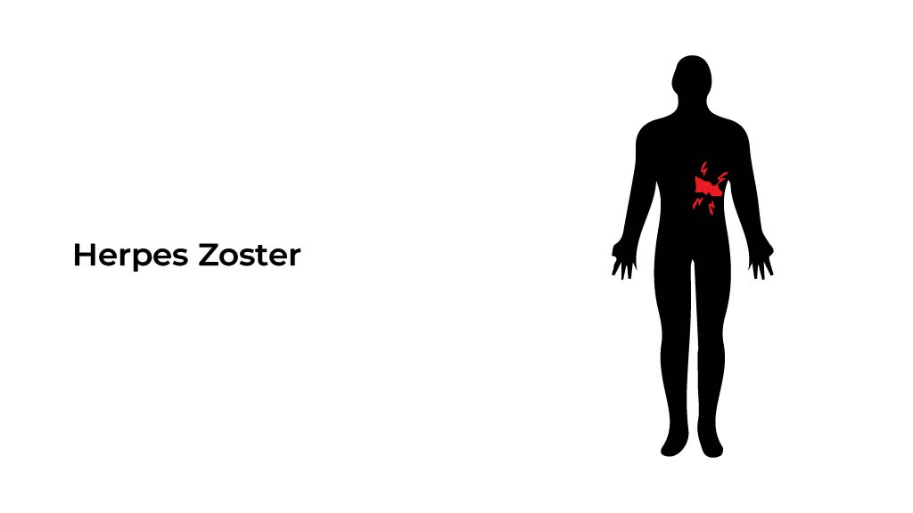 herpes-zoster